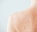 Psoriasis-Like Inflammation Limits Skin Cancer Growth