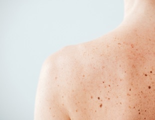 Psoriasis-Like Inflammation Limits Skin Cancer Growth