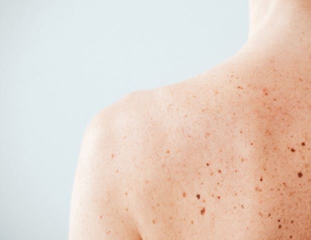 Psoriasis-Like Inflammation Limits Skin Cancer Growth