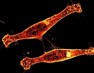 How Toxic Protein Spreads in Huntington’s Disease