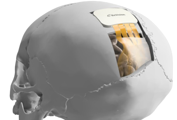 A grayscale illustration of a human skull with a portion removed, showing an implanted device with electrodes placed on the brain.