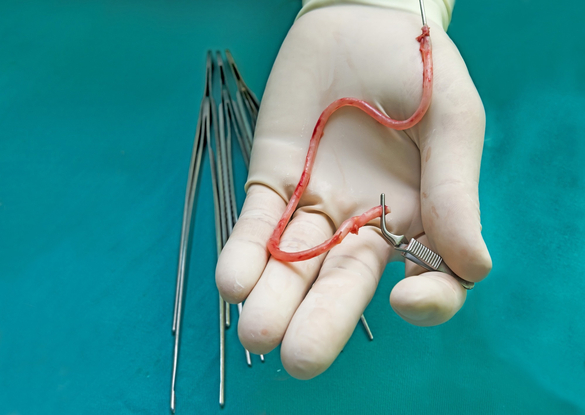 Saphenous vein graft after harvesting