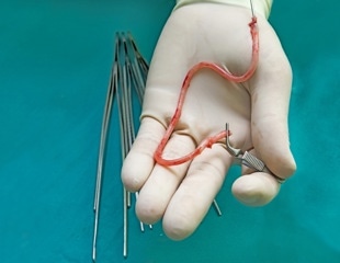 Regenerative Vascular Grafts Solve Key Shortage In Surgery