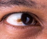 Semen-Derived Exosomes Eye Drops to Treat Retinoblastoma