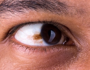 Semen-Derived Exosomes Eye Drops to Treat Retinoblastoma