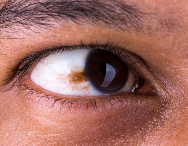 Semen-Derived Exosomes Eye Drops to Treat Retinoblastoma