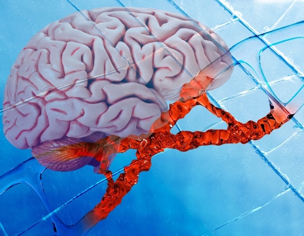 RNU2-2 Variants Drive Most Common Recessive Neurodevelopmental Disorder