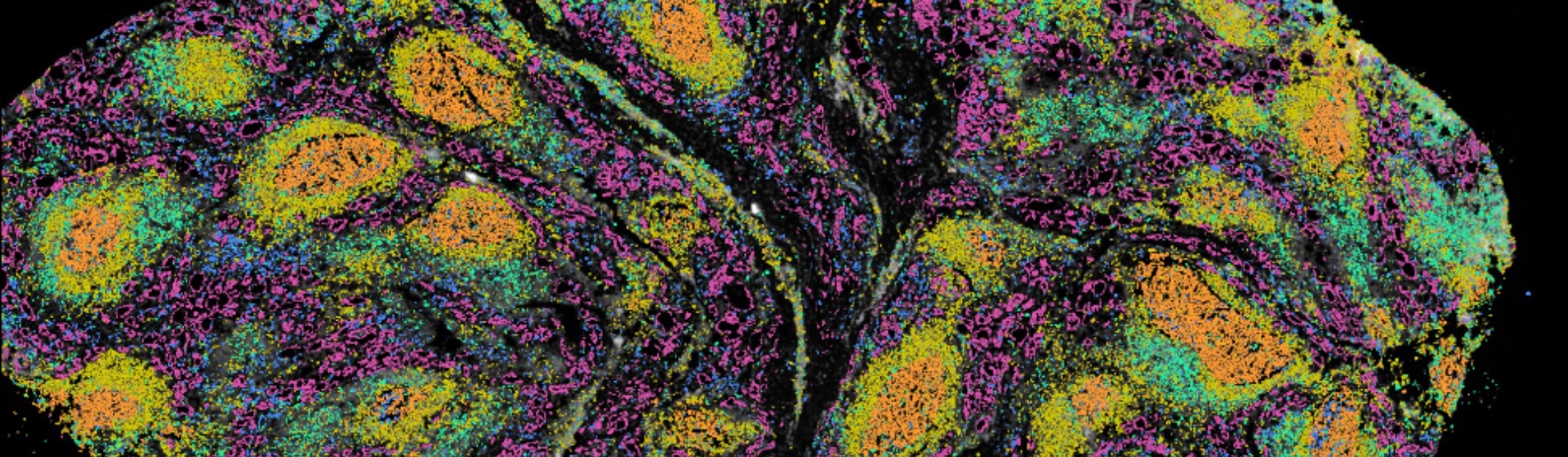 Identifying Somatic Driver Mutations in Thyroid Autoimmune Disease