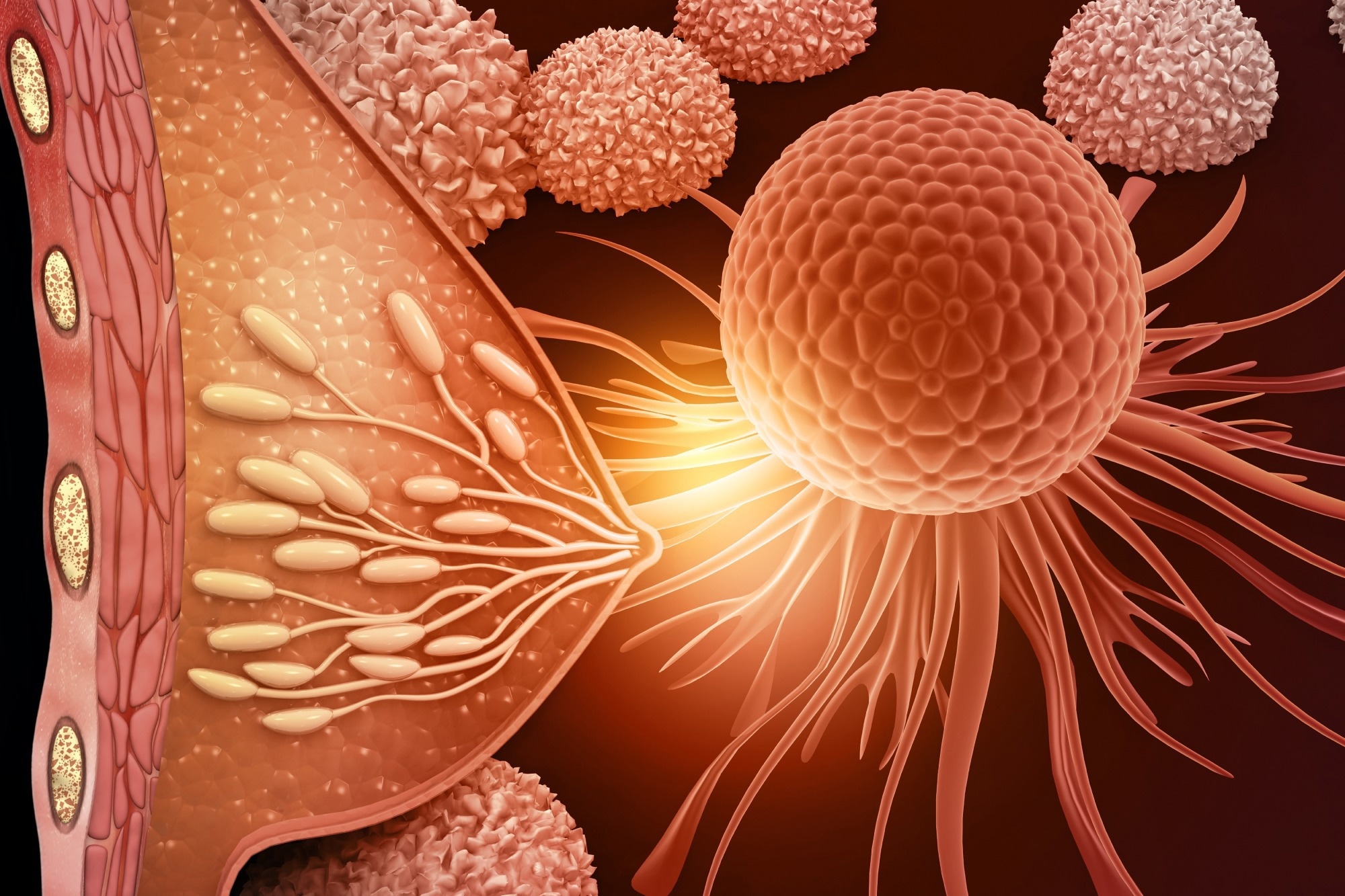 Female breast cancer, Breast anatomy with cancer cells. 3d illustration