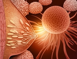 Intermediate PRRX1 Levels Drive Breast Cancer Metastasis Risk