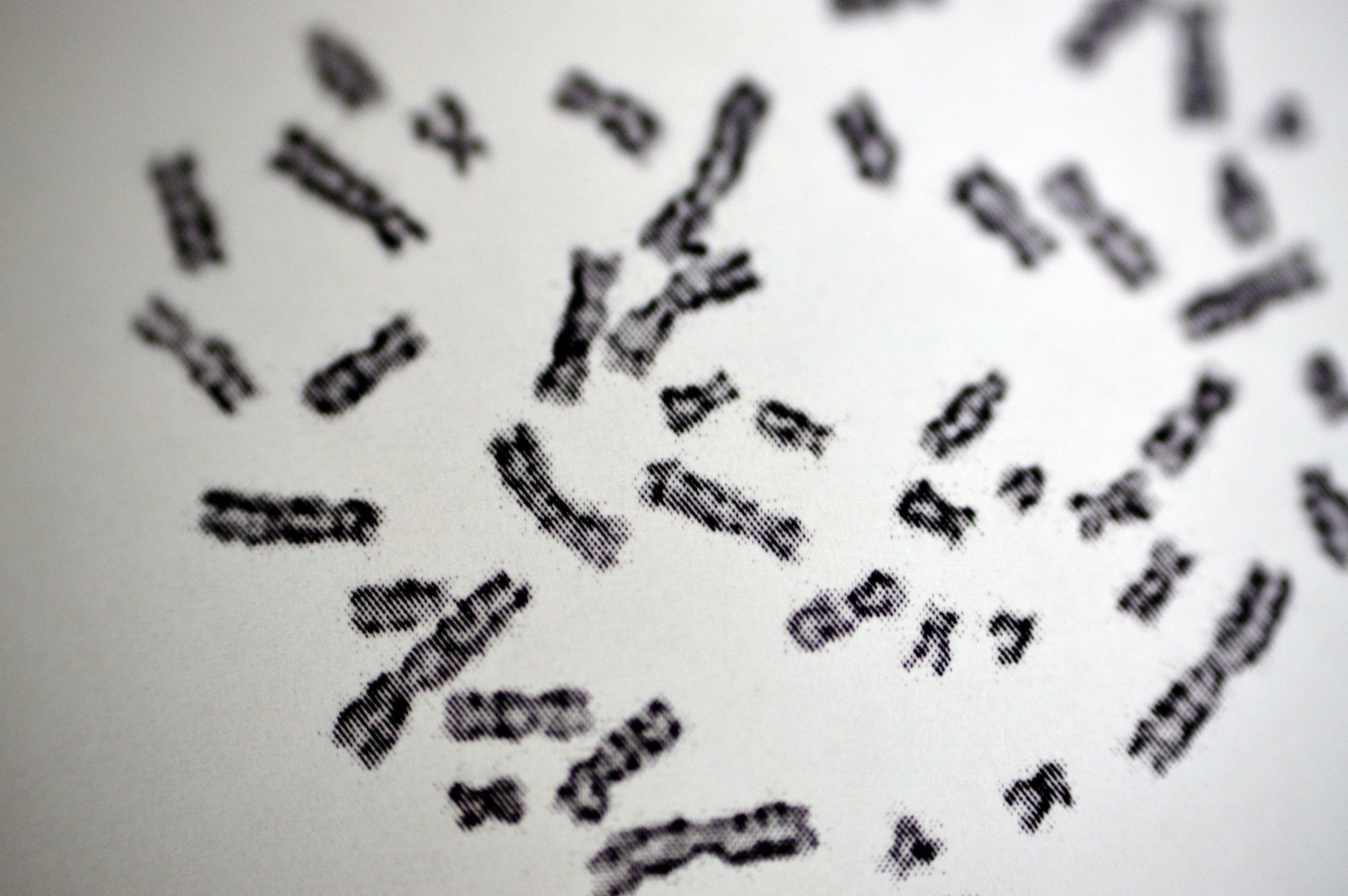 Normal female karyotyping, 46 XX, specimen collected from peripheral blood
