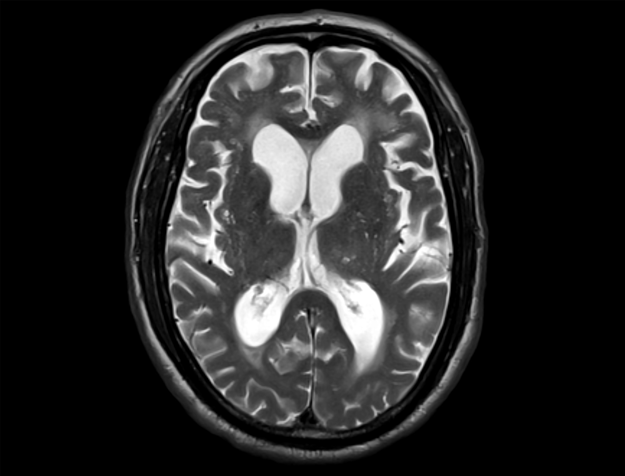 T2-weighted MRI brain image showing ventriculomegaly with clearly dilated ventricles.  Ideal for diagnosing hydrocephalus, CSF buildup, and neurodevelopmental abnormalities.