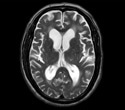 A Possible Brain Fluid Recycling System In Humans
