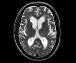 A Possible Brain Fluid Recycling System In Humans