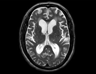 A Possible Brain Fluid Recycling System In Humans
