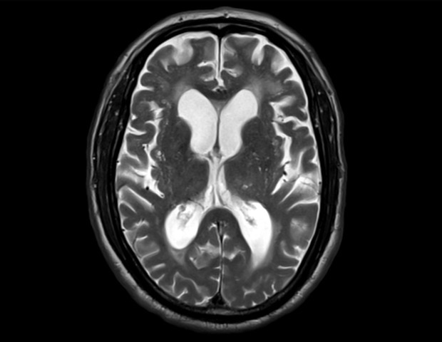 A Possible Brain Fluid Recycling System In Humans
