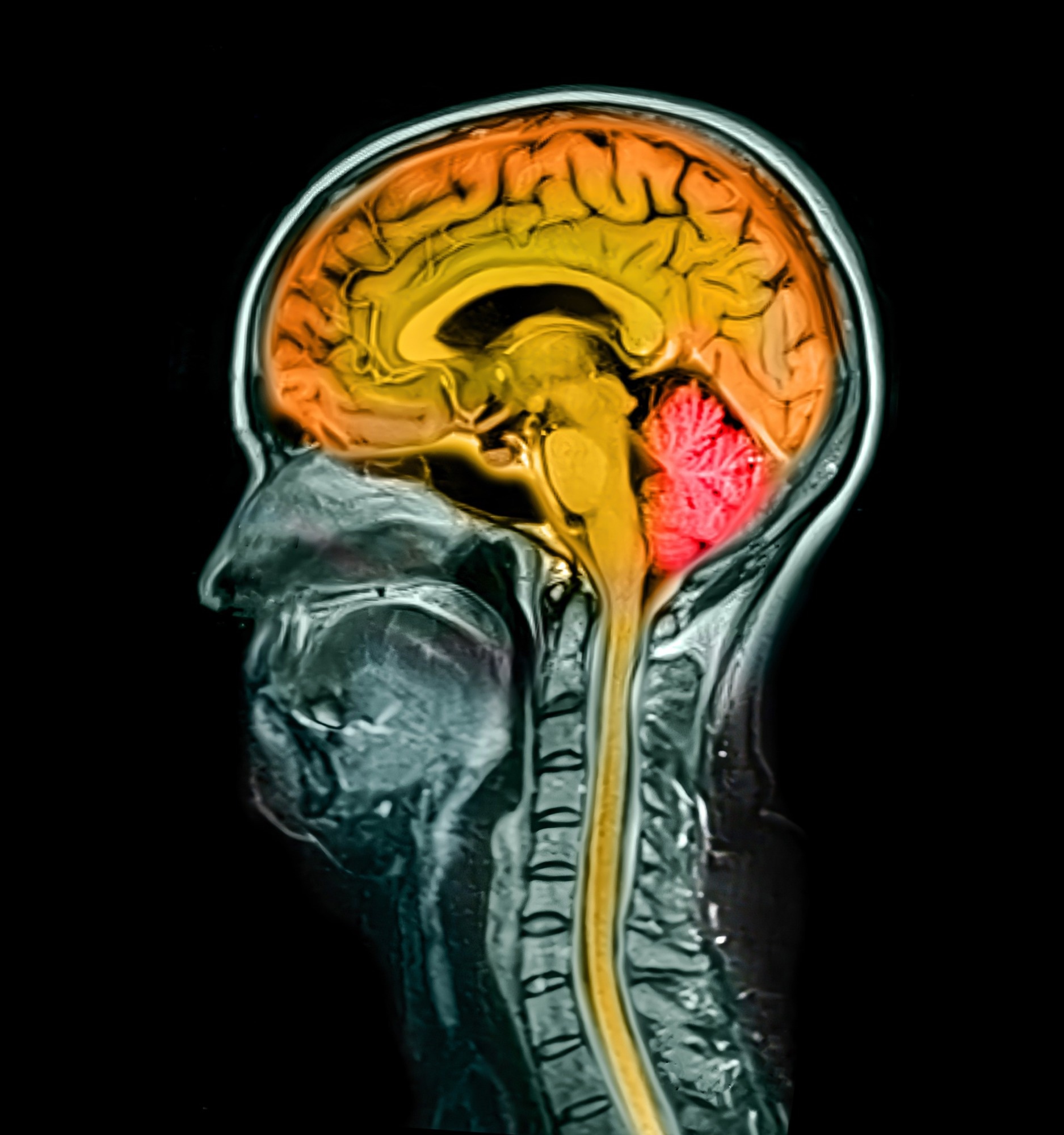 Colored composite magnetic resonance imaging (MRI) image of brain from a 44-year-old patient, with brain and spinal cord highlighted in orange and cerebellum in red.