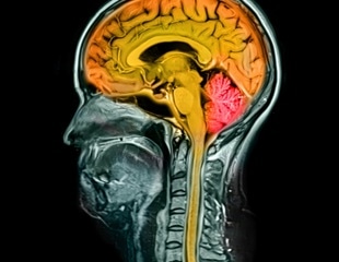 Drug Boosts Axon Regrowth In Human Brain-Spinal Cord Model