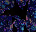 Blood Signature Found to Predict Lung Cancer Risk Years Before Diagnosis