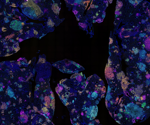 Blood Signature Found to Predict Lung Cancer Risk Years Before Diagnosis