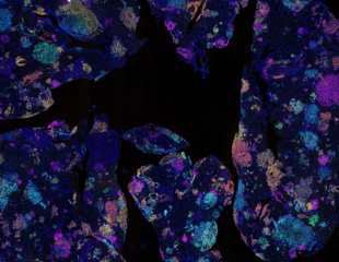 Blood Signature Found to Predict Lung Cancer Risk Years Before Diagnosis