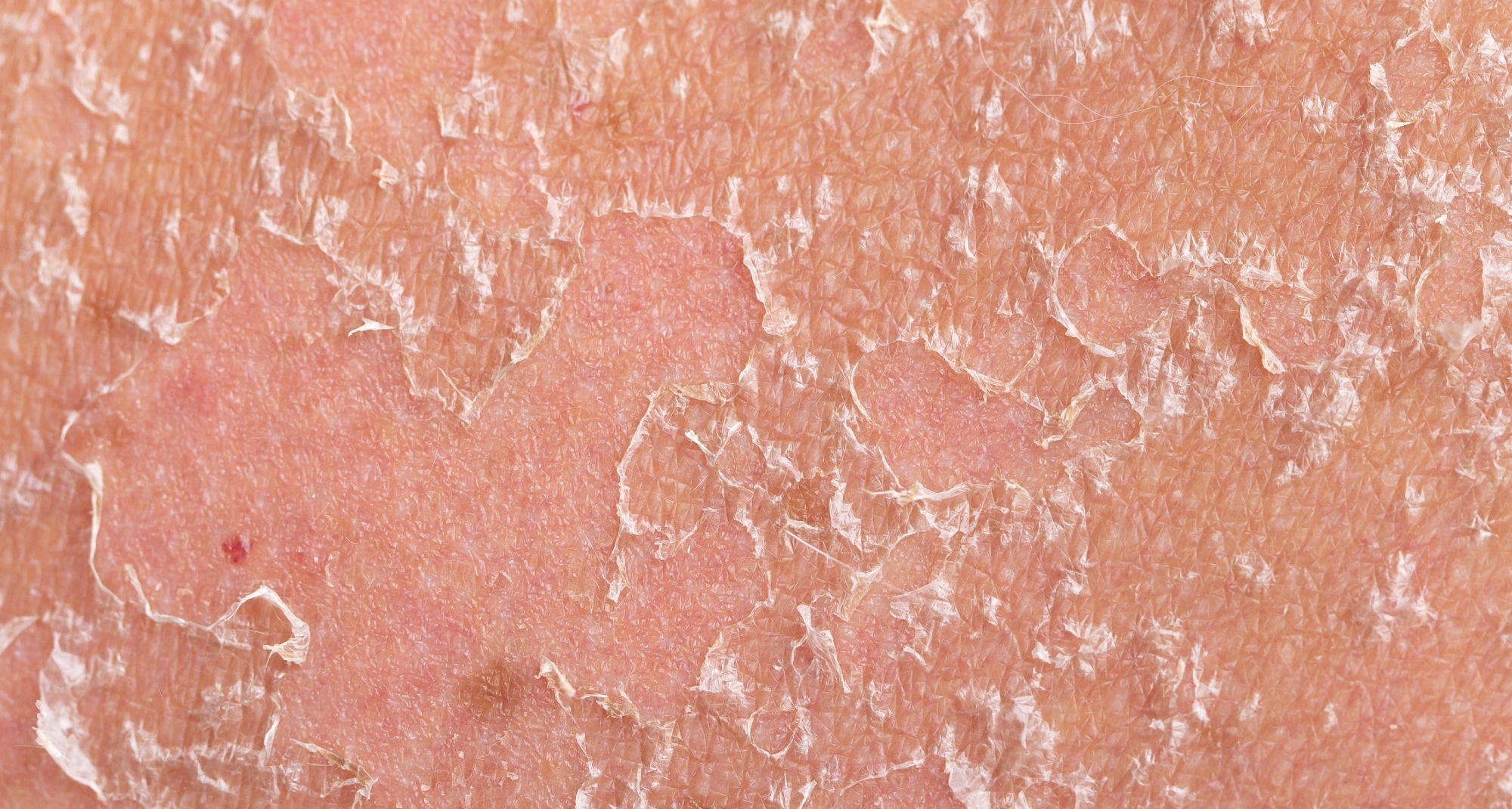 Sunburn, close-up of human skin. Flaky skin from allergies, peeling or eczema. Dry skin in need of treatment and hydration.