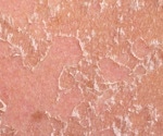 New Study Reveals How Skin Immune Cells Shape Long-Term Health