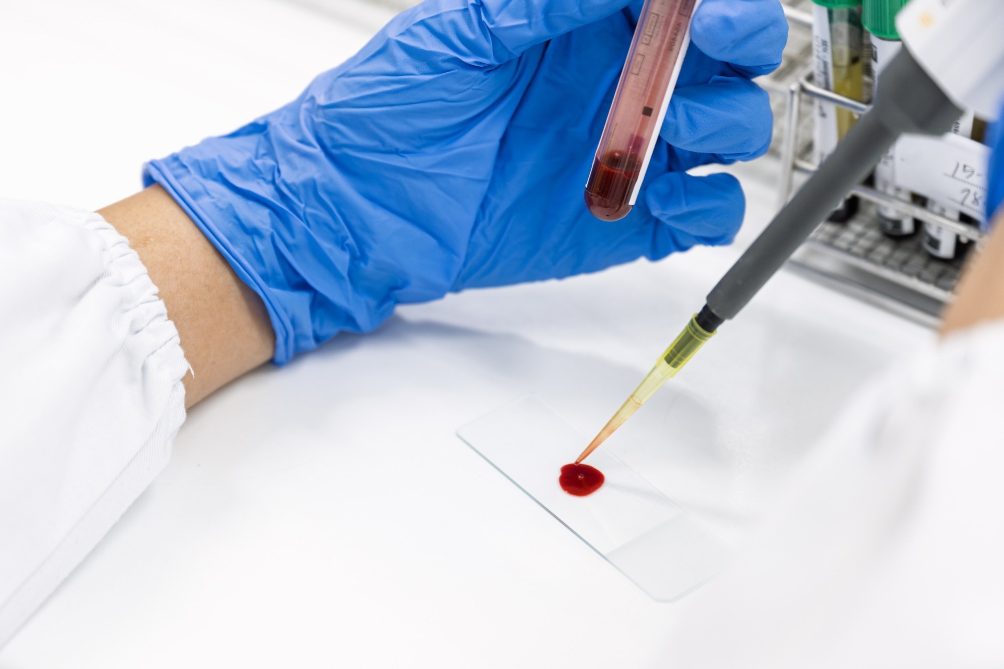 Laboratory technician using a pipette to transfer a blood sample onto a microscope slide while holding a blood collection tube.