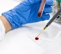 Antibody Drug Conjugate Treatment Destroys Hidden B Cell Leukemia