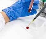 Antibody Drug Conjugate Treatment Destroys Hidden B Cell Leukemia