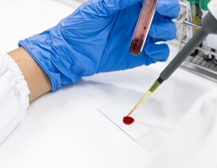 Antibody Drug Conjugate Treatment Destroys Hidden B Cell Leukemia