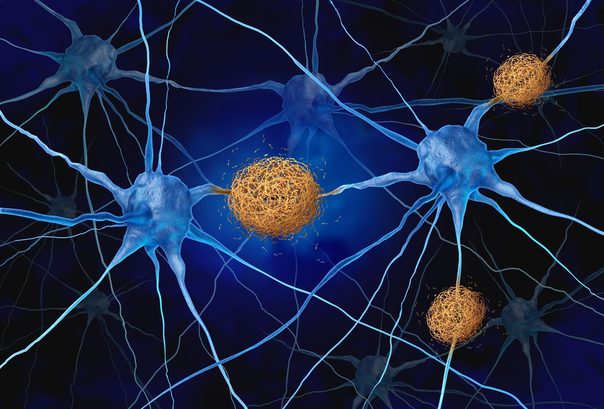 Amyloid Plaques concept as abnormal clusters of protein fragments that accumulate between nerve cells in the brain resulting in degenerative disease as Alzheimers and dementia as a 3D illustration.