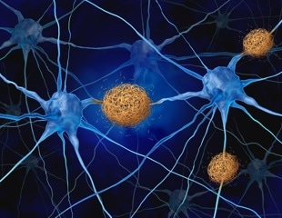 Arc Protein Identified as Driving Tau Spread in Alzheimer's Disease
