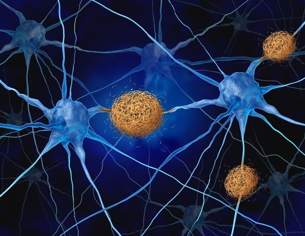 Arc Protein Identified as Driving Tau Spread in Alzheimer's Disease