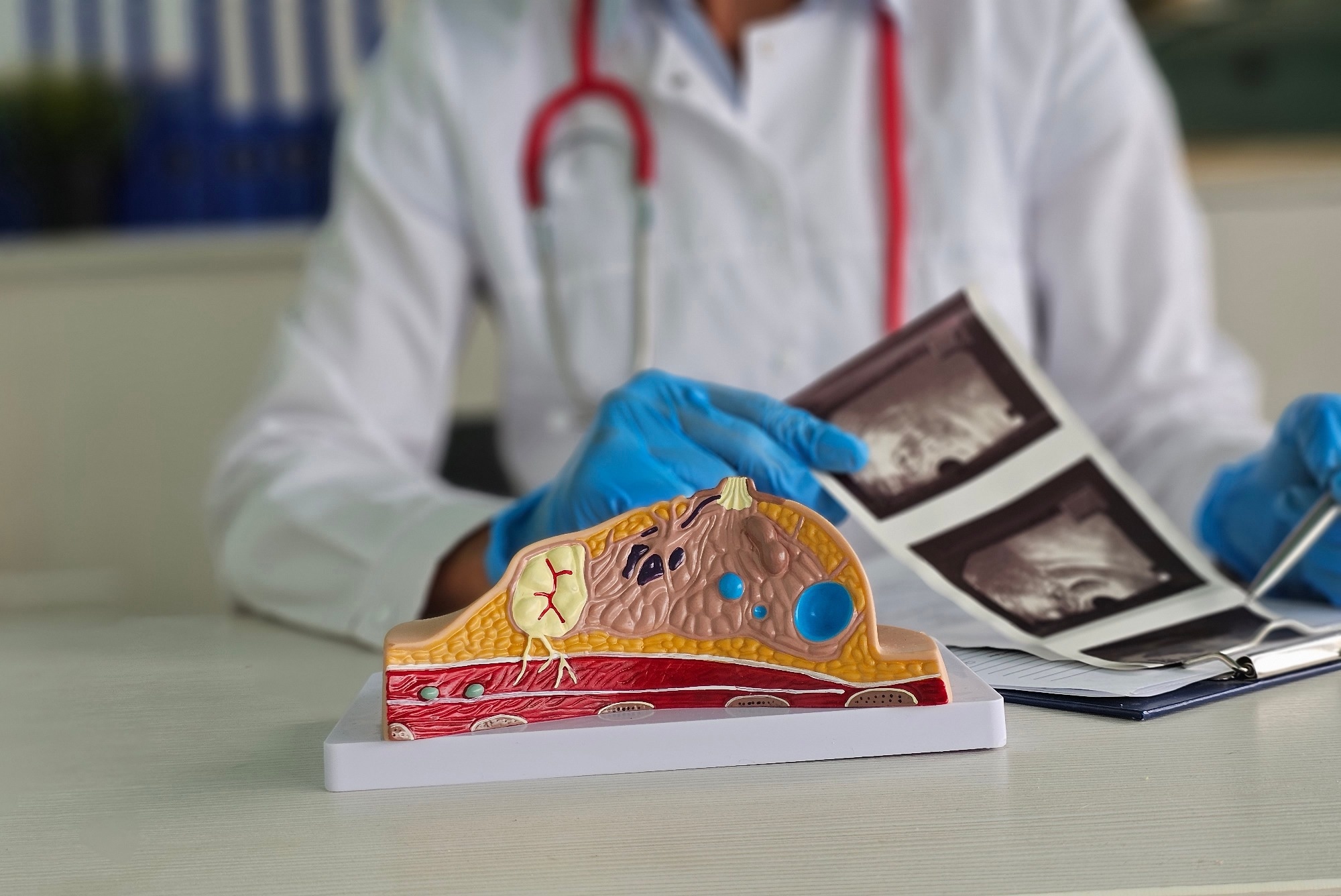 doctor holds mammary scans with breast cancer model