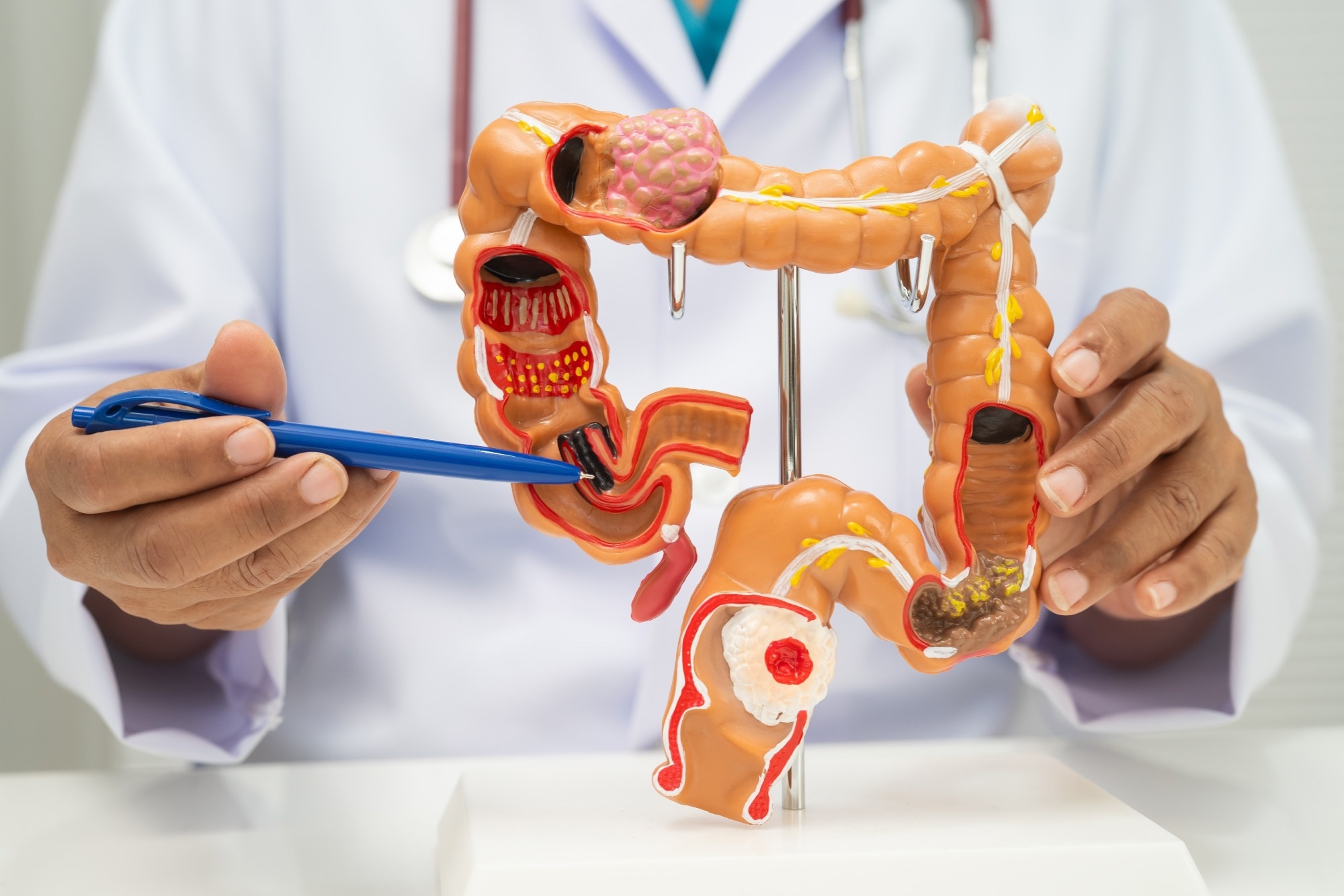bowel cancer