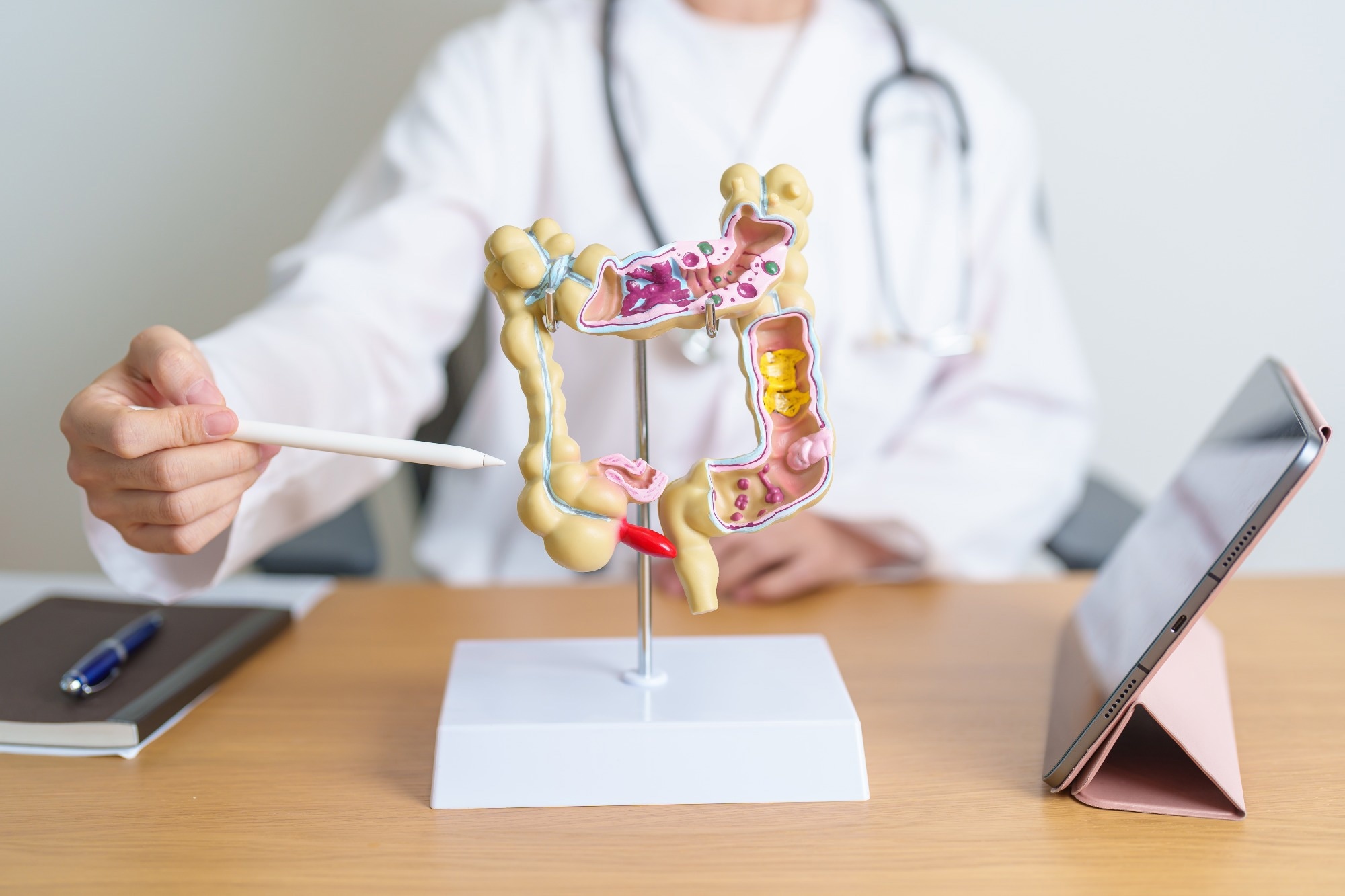 colorectal cancer, bowel cancer model