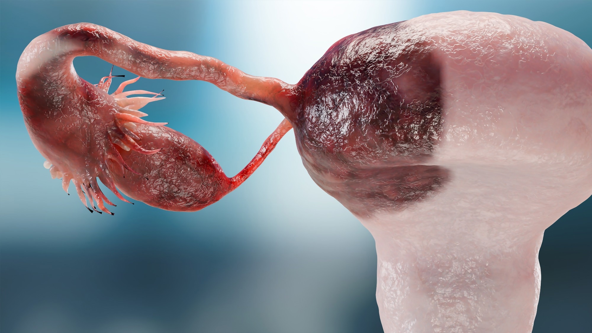 3D illustration of an ovary, fallopian tube, and uterus affected by ovarian cancer.