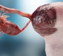 USP15 Protein May Help Ovarian Cancer Resist Chemotherapy