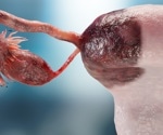 USP15 Protein May Help Ovarian Cancer Resist Chemotherapy