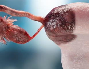 USP15 Protein May Help Ovarian Cancer Resist Chemotherapy