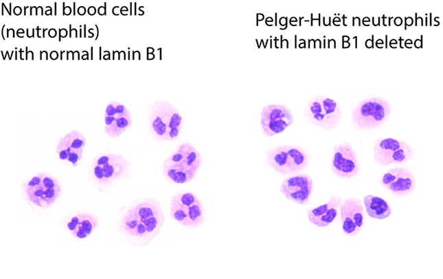 Researchers discover abnormal gene mutations that lead to cancer development