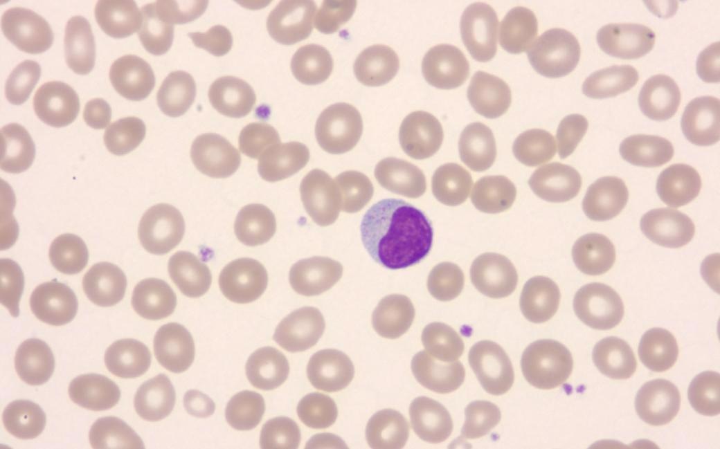 Researchers analyze the body’s immune cells with blood cancer cells