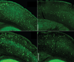 Critical signaling pathways in immune cells could reduce Alzheimer’s progression