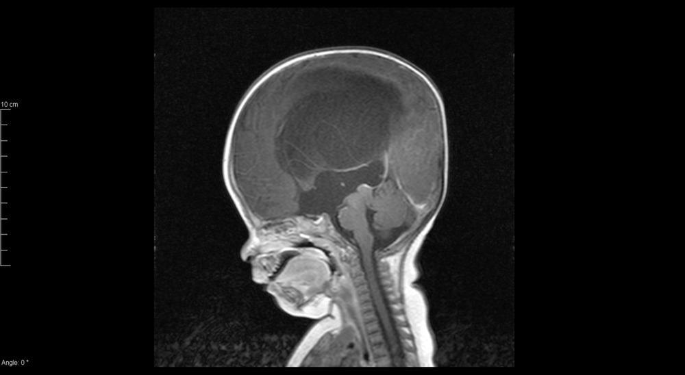 hydrocephalus