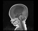 Genomics provides a deeper understanding of the cause of hydrocephalus
