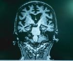 Researchers analyze single-cell DNA sequencing for having a significant role in Alzheimer’s disease