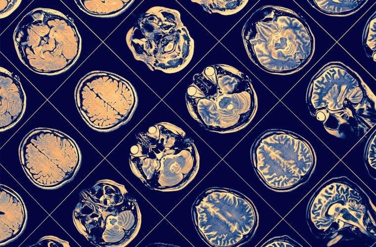 New research offers the most insight on the genetic basis of schizophrenia