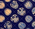 New research offers the most insight on the genetic basis of schizophrenia