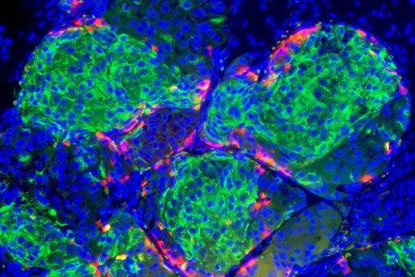Giving attention to beta cells instead of the immune system could be a chance to prevent type 1 diabetes
